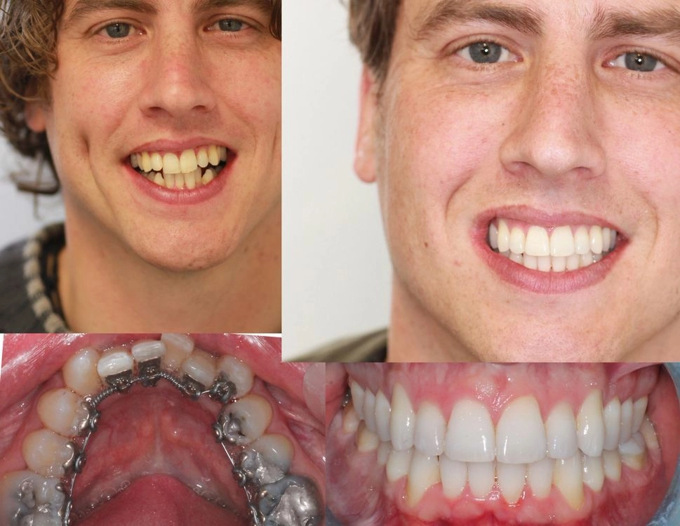 Before and After of Orthodontist in Bournemouth Patient
