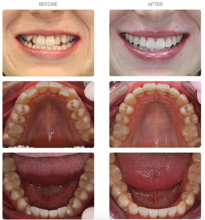 Invisalign Before and After in Bournemouth