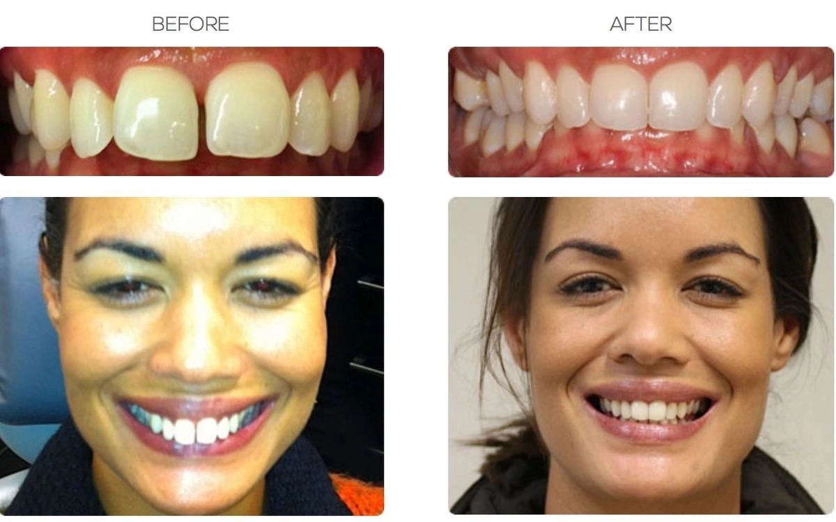 Invisalign & Braces for Gaps: Before and After Results