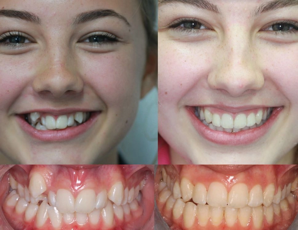 Why Are Some Braces High On Teeth at Corinne Hansen blog