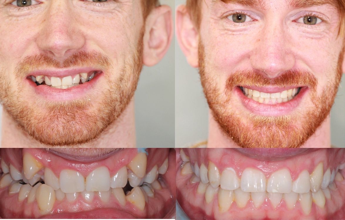 Before After Magic Transformational Power Of Braces On Teeth